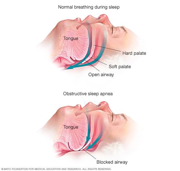 Uống rượu làm lưỡi dễ dàng bị thả lỏng và chèn vào đường thở.