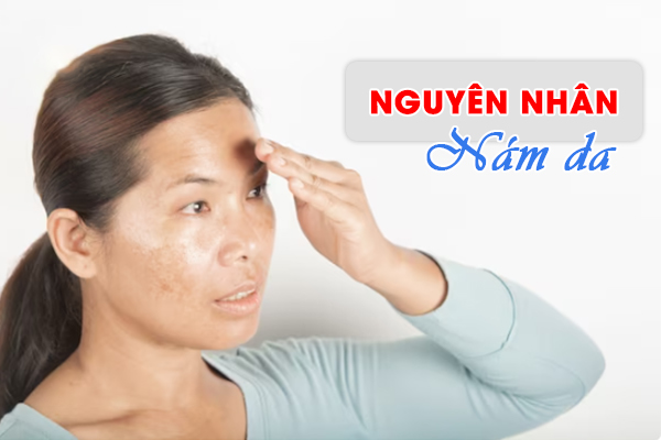 Tại sao bạn bị nám da