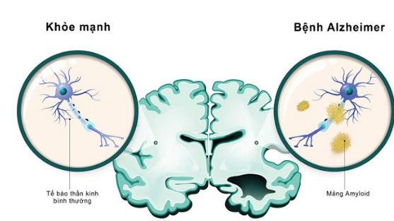 Cơ chế gây bệnh Alzheimer