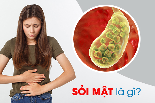 Sỏi mật là gì?