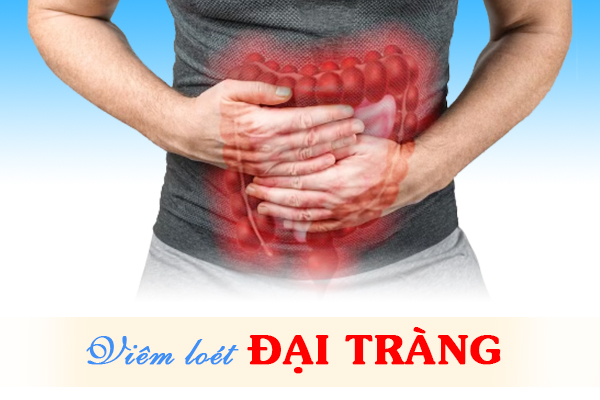 Thay đổi ở phân là dấu hiệu viêm loét đại tràng.