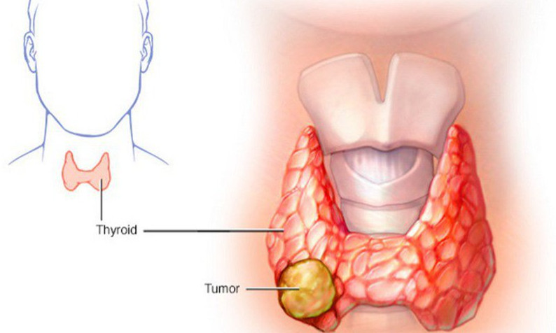 U tuyến giáp có nguy hiểm không? Dấu hiệu u tuyến giáp là gì?