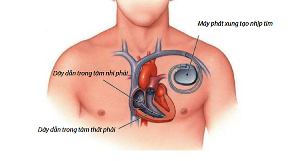 Người bệnh có thể phải dùng máy tạo nhịp tim trong trường hợp nặng