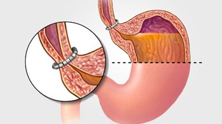 Thắt cơ vòng thực quản bằng thiết bị từ tính