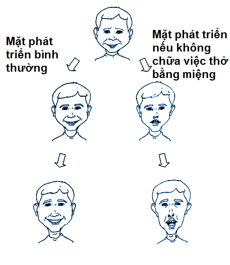 Hình ảnh minh họa bộ mặt VA ở trẻ