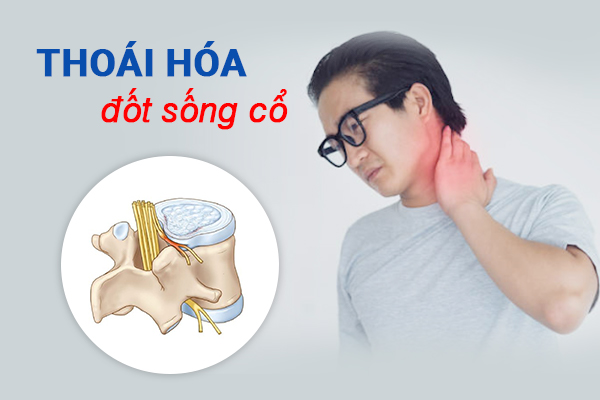 Thoái hóa đốt sống cổ do nguyên nhân gì?