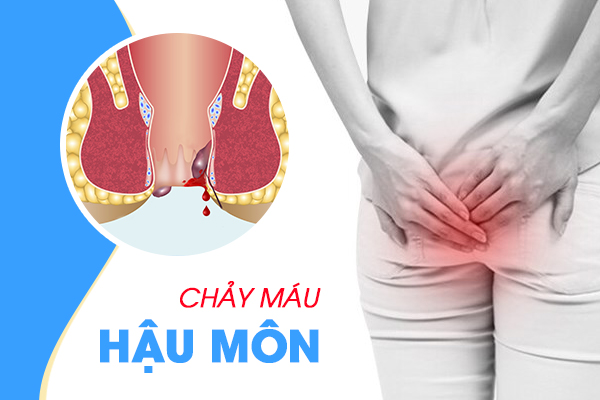 Chảy máu hậu môn do bệnh gì?