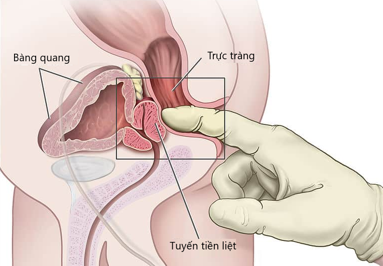 Vị trí tuyến tiền liệt