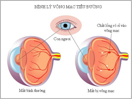 Biến chứng trên mắt ở bệnh nhân tiểu đường 