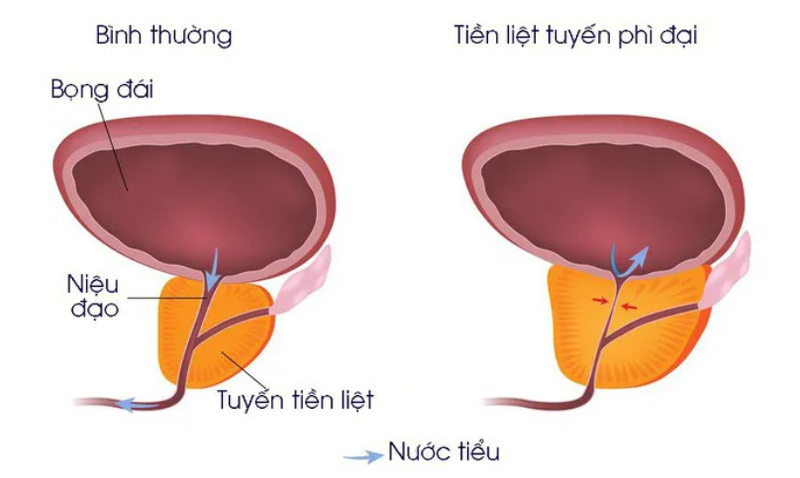 Cần khám những gì để biết mình bị phì đại tiền liệt tuyến? Khi nào cần mổ, khi nào không?