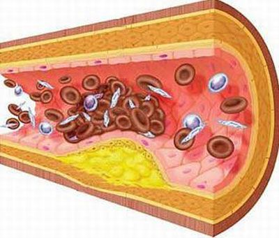 Hỏi: Tai biến nhưng vẫn bị mỡ máu