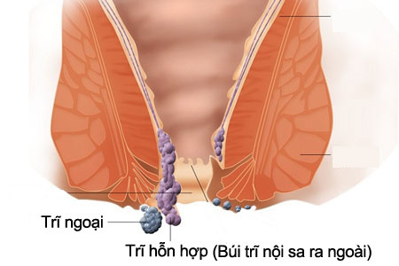 trĩ hỗn hợp