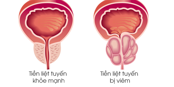 Viêm đường tiết niệu - Biến chứng hay gặp của phì đại tiền liệt tuyến